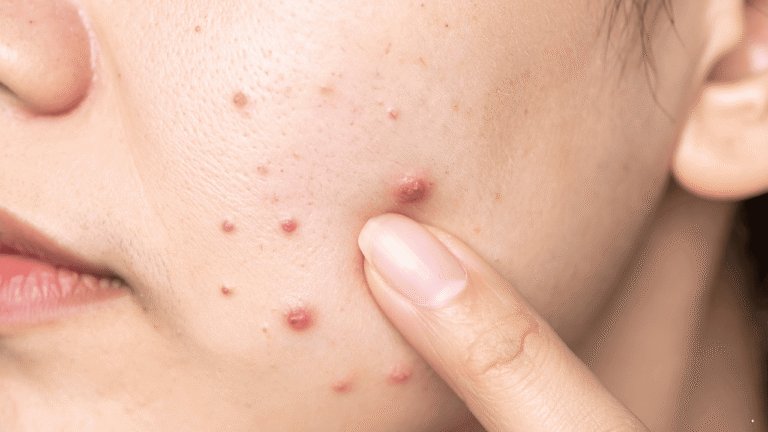 Tak Perlu Mahal, Ini Tips Mengatasi Jerawat Secara Sederhana
